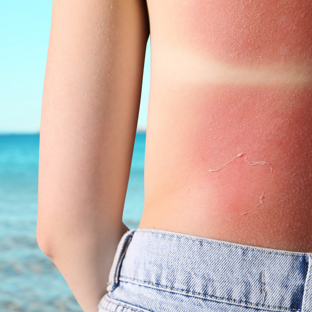 How to Soothe a Minor Burn or Sunburn at Home