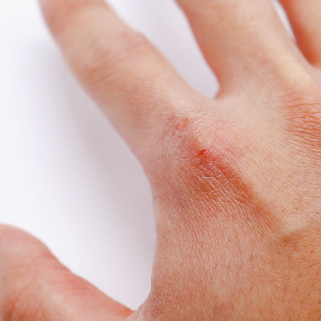Dry, Cracked Hands: Causes and How to Fix Them