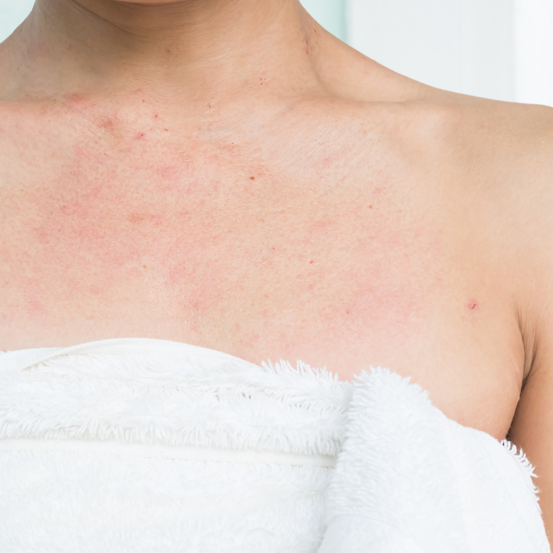Why Does Eczema Get Worse at Night? How to Calm It