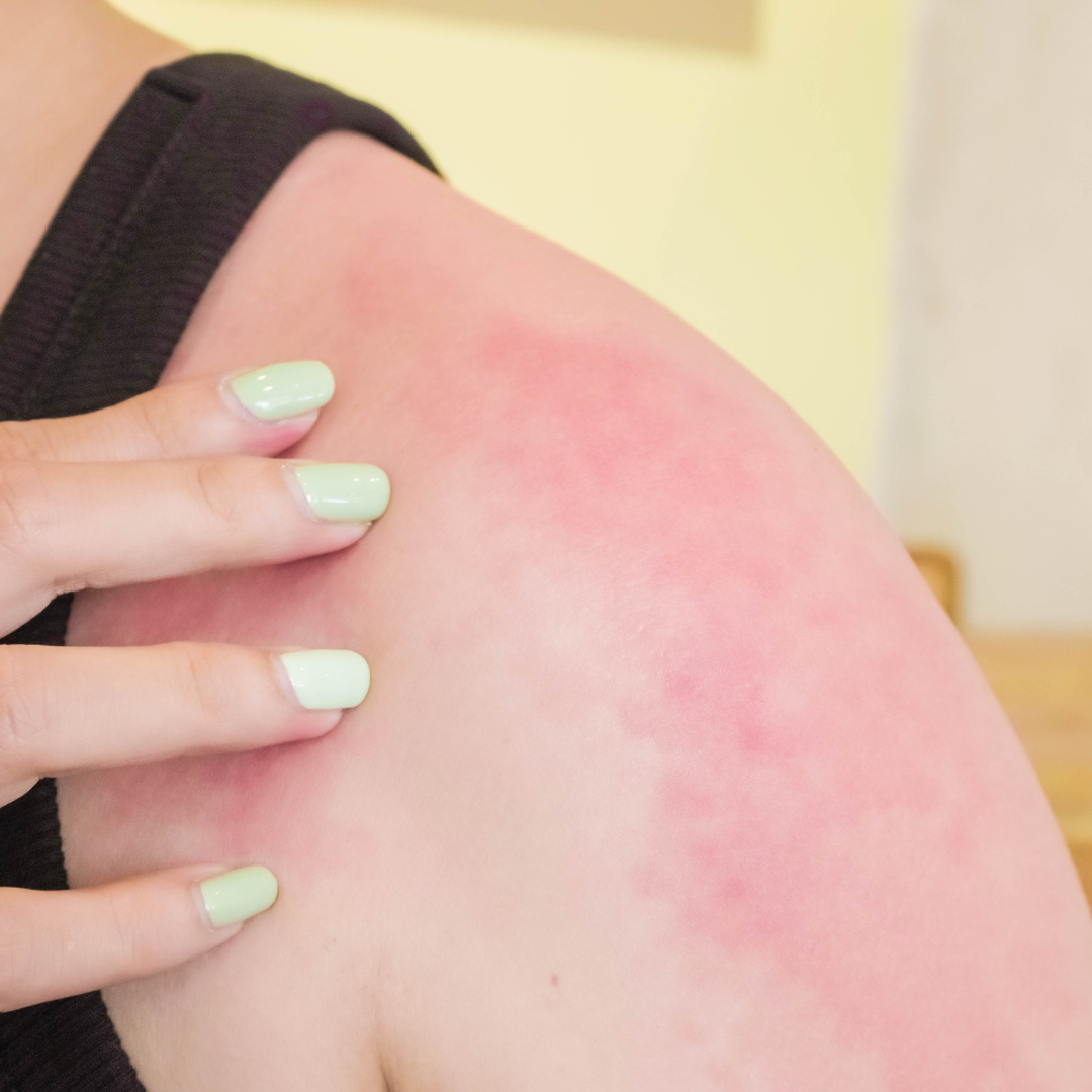 Signs a Flare-Up Is Coming Before It Happens