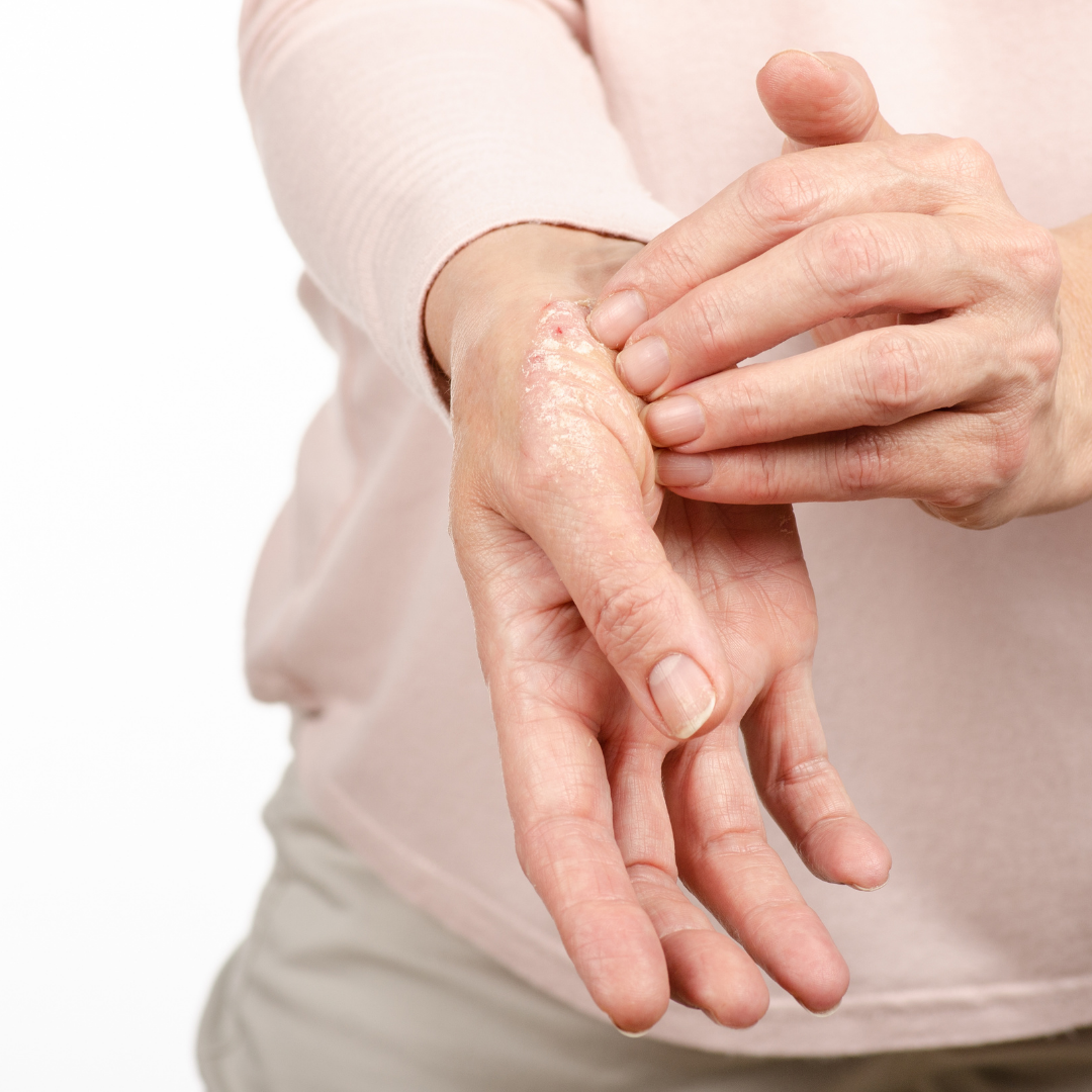 Is Manuka Honey Good for Psoriasis? What to Know