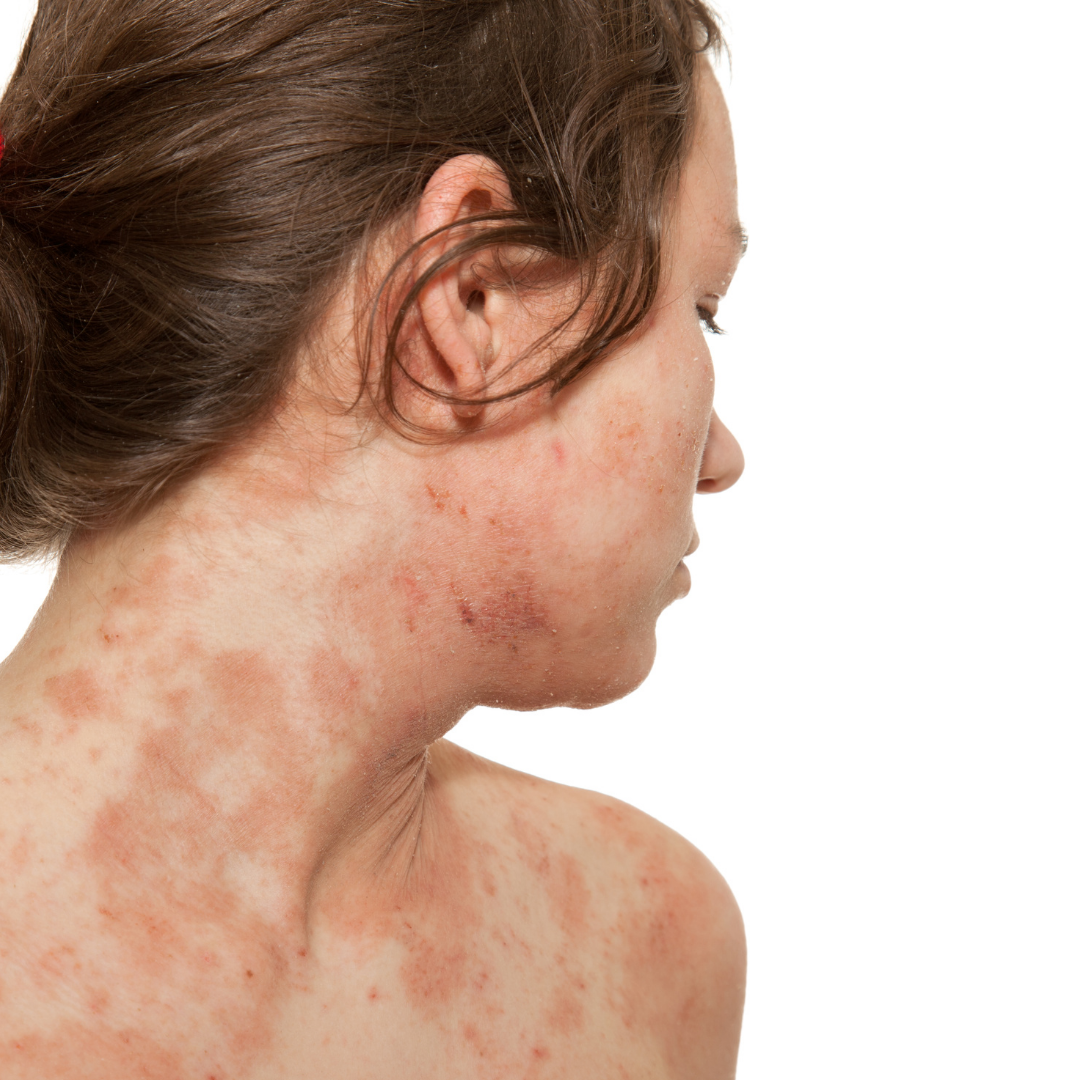 What Causes Contact Dermatitis and How to Soothe It