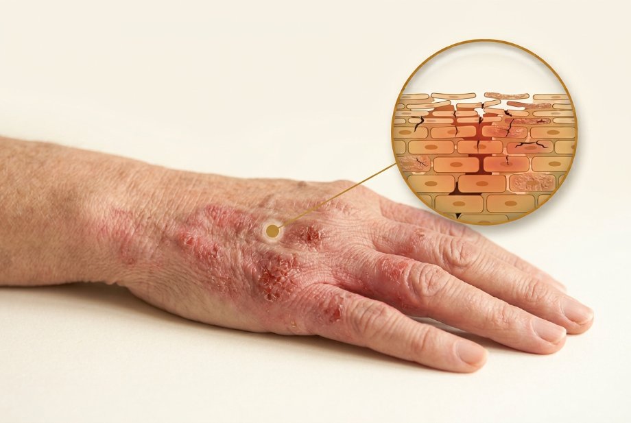 Dry eczema-prone hand with a magnified view of gaps between the skin cells