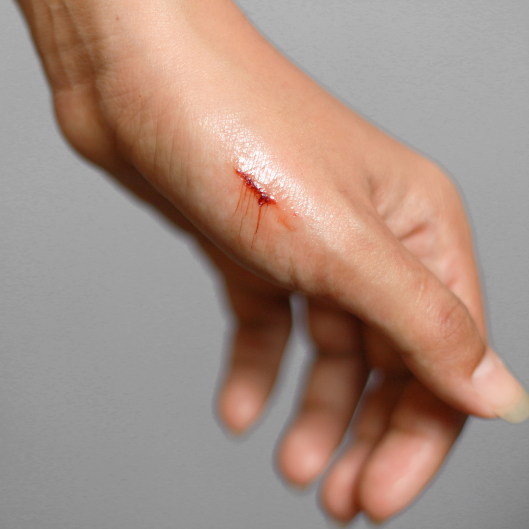 Is Manuka Honey Good for Cuts and Wounds?