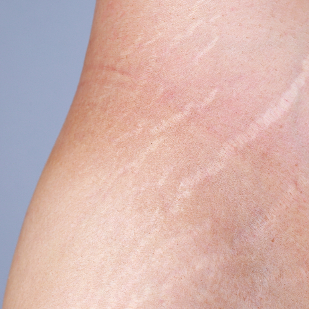 How to Improve the Appearance of Scars and Stretch Marks