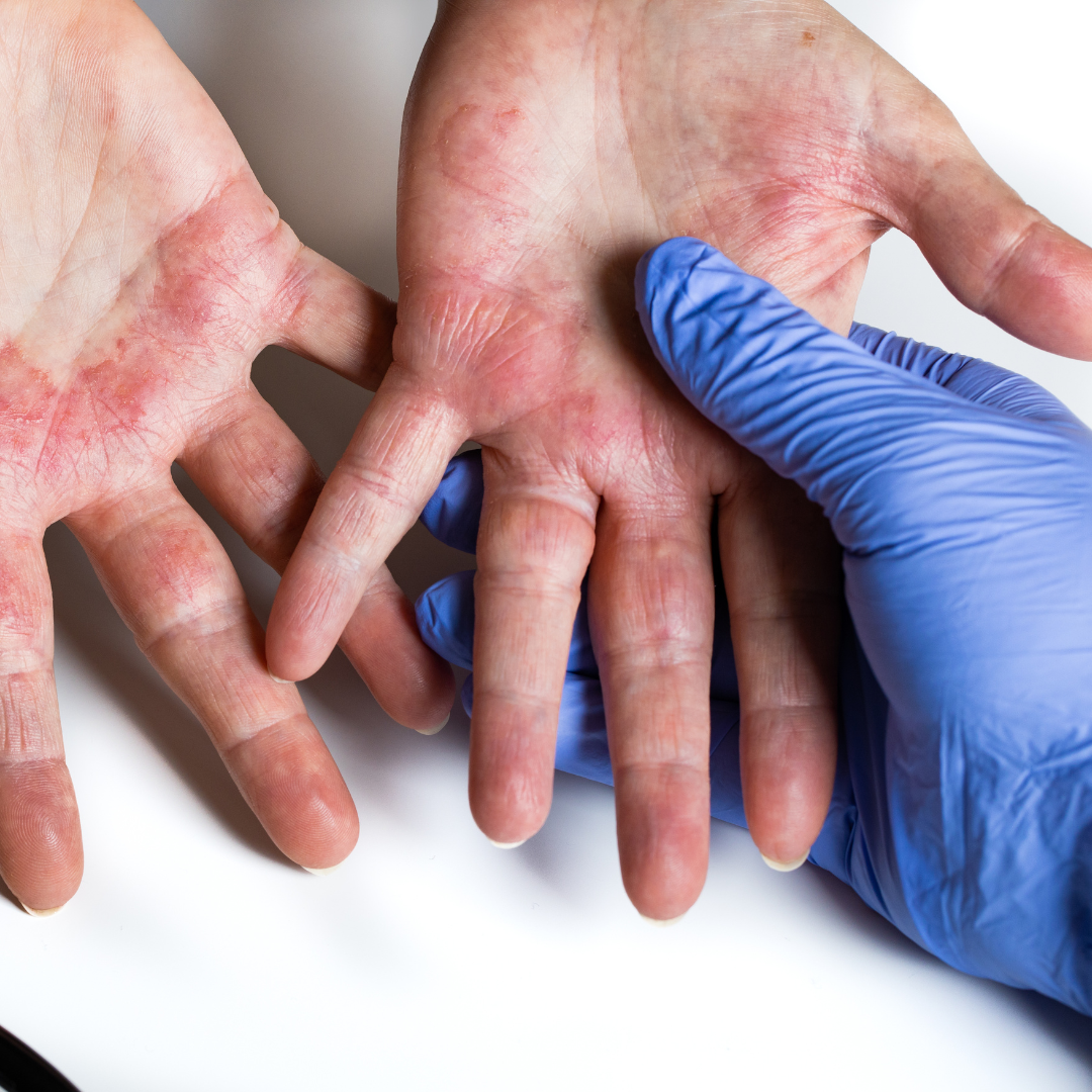 Why Eczema, Psoriasis & Dermatitis Often Respond Better to Natural Formulations
