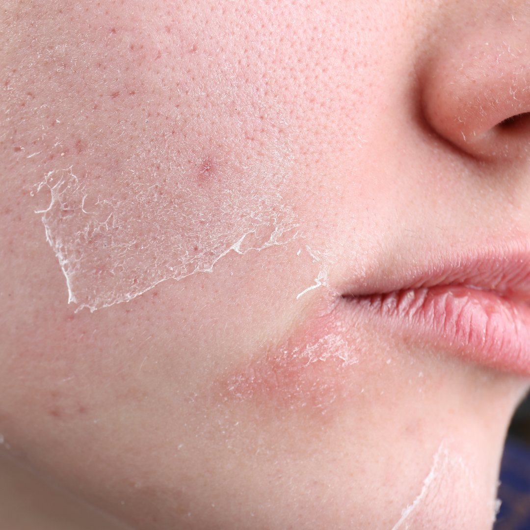 How to Soothe Flaky Skin on Your Face