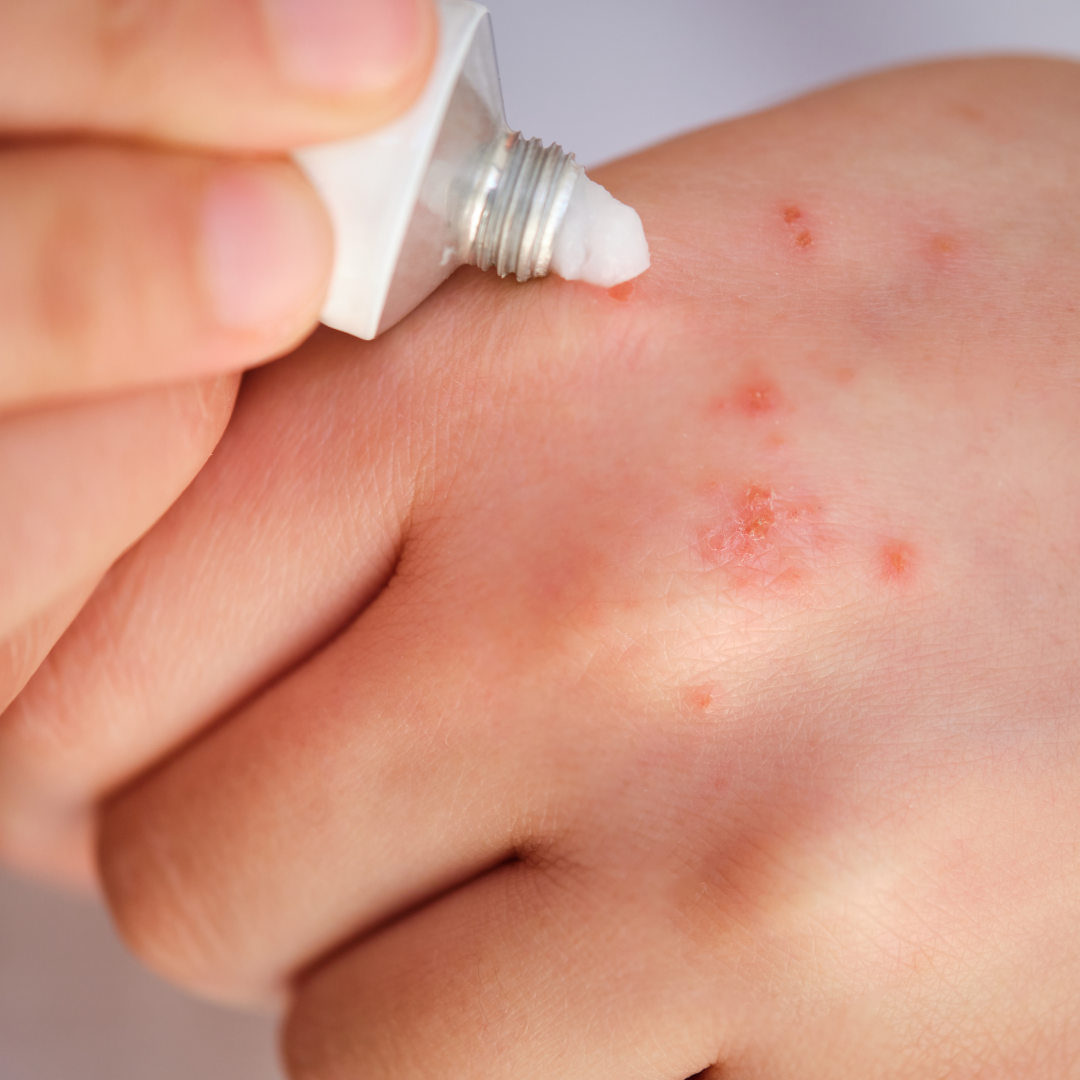 What Happens to Your Skin When You Use Steroid Creams Long-Term?