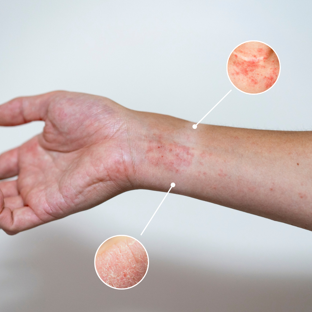 Contact Dermatitis vs. Eczema: How to Tell Them Apart