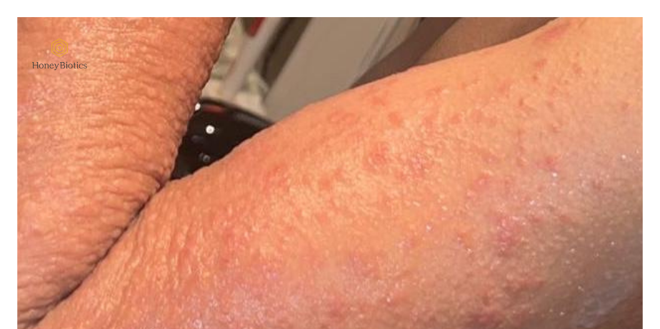 Before - eczema flare on inner arm
