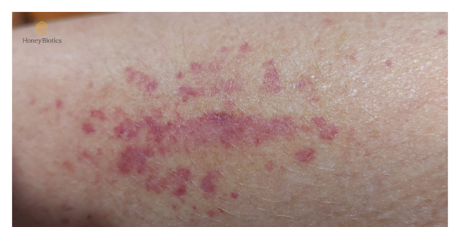 Before - eczema rash on arm