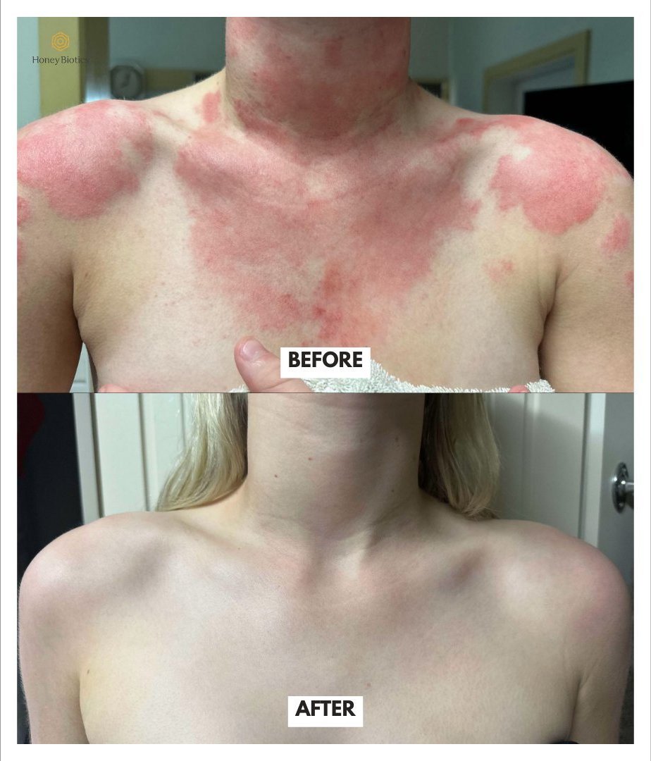 Before and after — eczema on arm