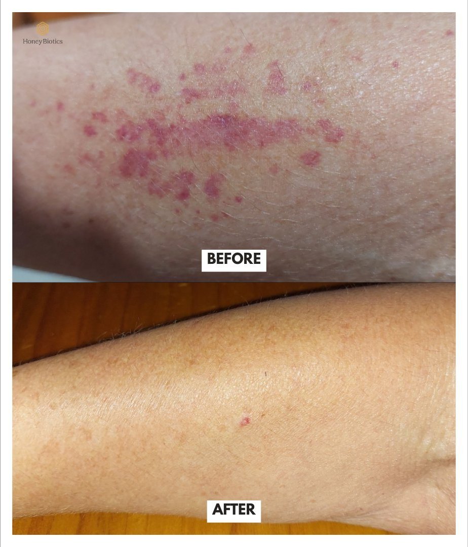 Before and after — chest redness