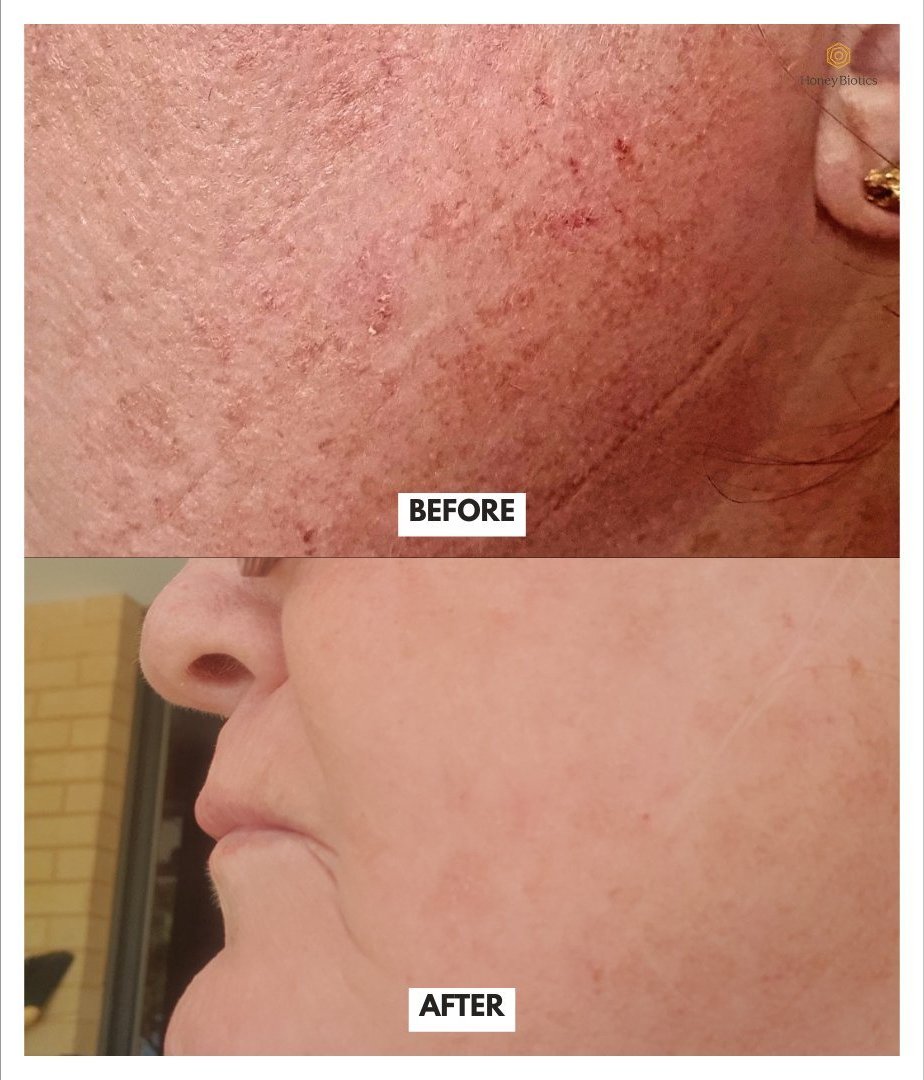 Before and after — forearm dermatitis