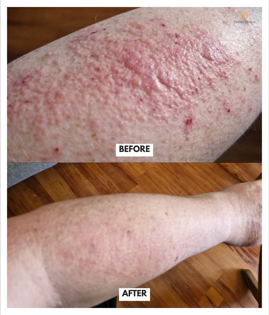 Before and after — arm flare-up