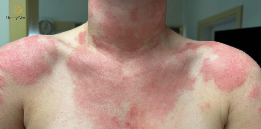 An eczema flare-up across the chest and neck