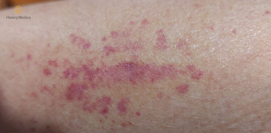 Before: itchy eczema rash on the arm