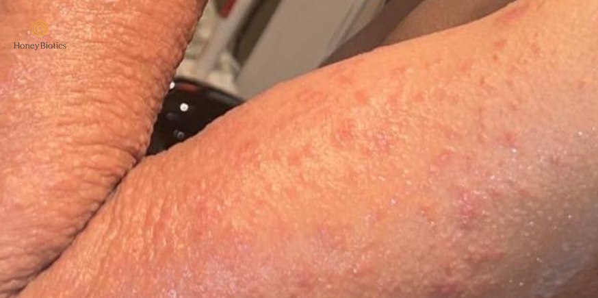 Before: eczema flare on the inner arm