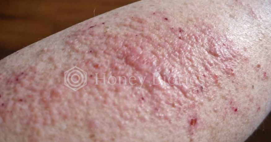 Before: red, raw skin on the leg
