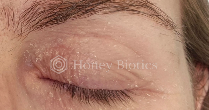 Before: dry, flaking eyelid dermatitis