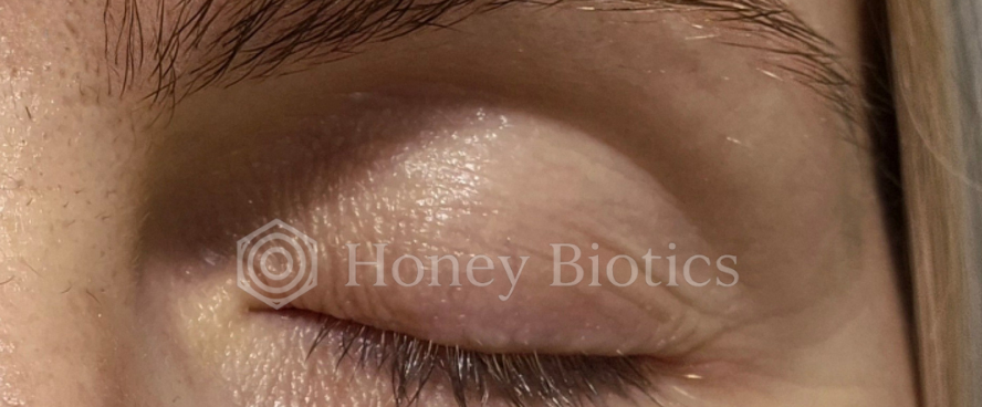 After: calm eyelid skin